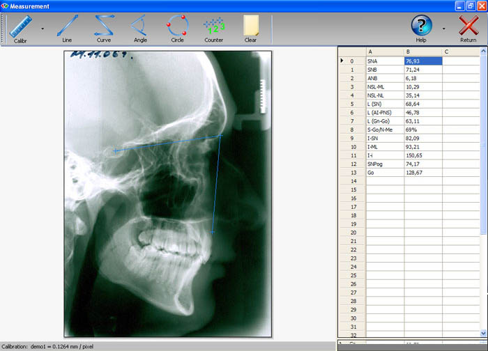 MMC Dent Lateral Radiography Measurement